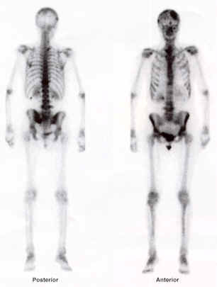 Bone Scan Whole Body