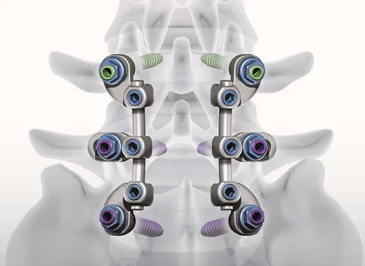 Surgical Fixation